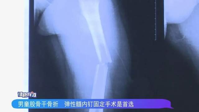 针对龙龙的股骨干骨折,徐州市儿童医院骨科为他采取了髓内钉内固定