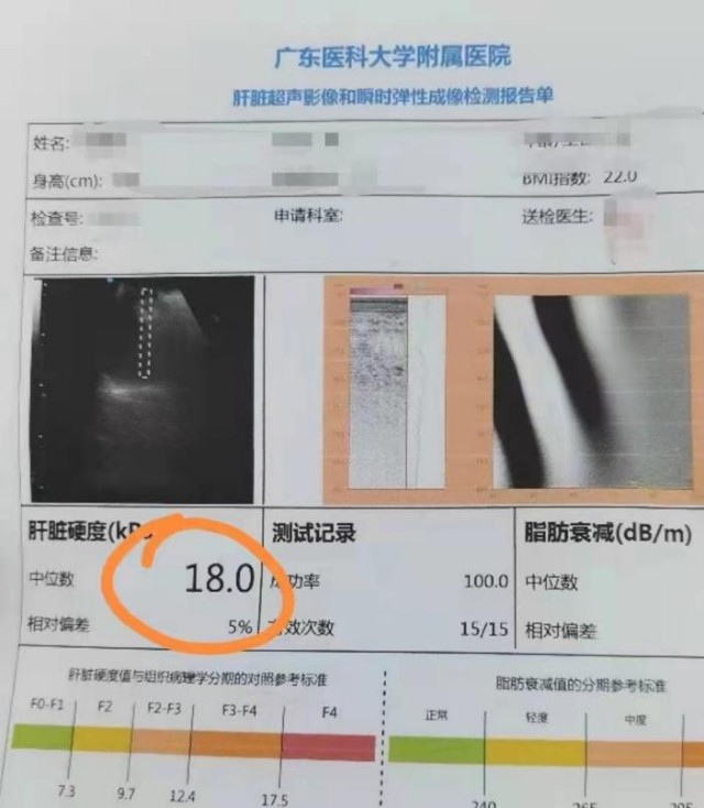 基层肝疾病早筛困境有望改善我国无创肝纤维化诊断系统正加速普及