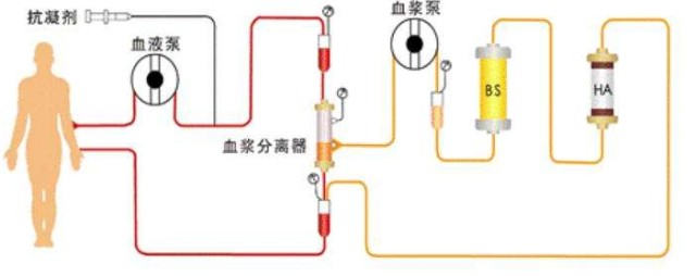 深度专业解读健帆生物人工肾人工肝血液透析净化的状况