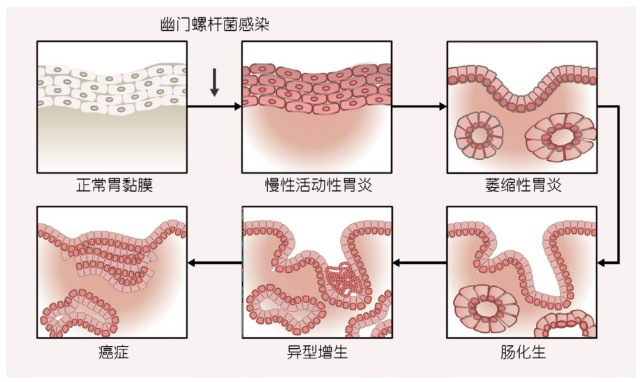 2020 年发表的《筛查与根除幽门螺杆菌预防胃癌:台北全球共识(简称"