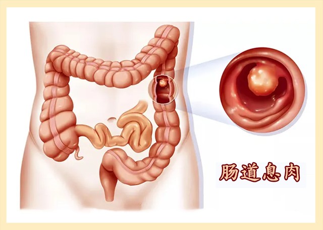 生态制剂小常宝科普肠长息肉是什么原因造成的