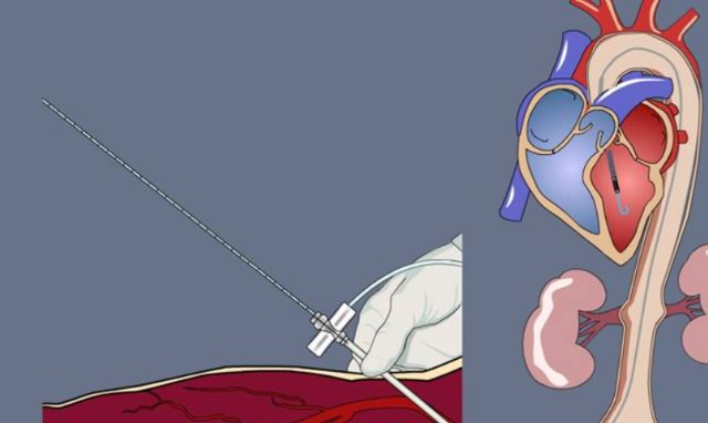 强生介入怎么样强生史上最大收购后，心衰赛道迎来新变数_https://www.jmylbn.com_新闻资讯_第3张