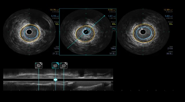 开立超声怎么导出图像步入冠脉精准化时代：开立高清IVUS获批上市_https://www.jmylbn.com_新闻资讯_第3张
