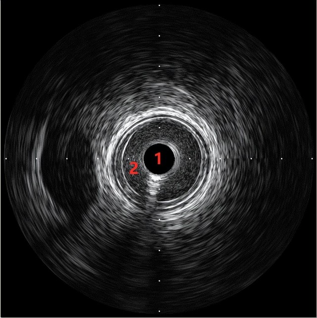 开立超声怎么导出图像步入冠脉精准化时代：开立高清IVUS获批上市_https://www.jmylbn.com_新闻资讯_第5张
