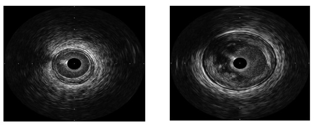 开立超声怎么导出图像步入冠脉精准化时代：开立高清IVUS获批上市_https://www.jmylbn.com_新闻资讯_第6张