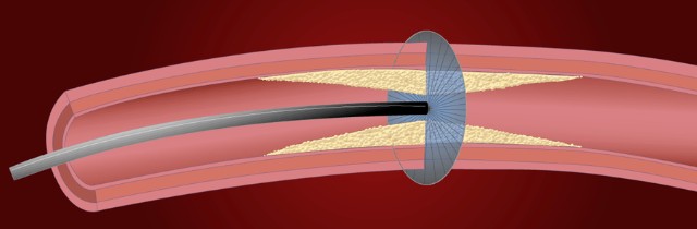 开立超声怎么导出图像步入冠脉精准化时代：开立高清IVUS获批上市_https://www.jmylbn.com_新闻资讯_第4张