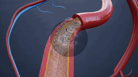 开立超声怎么导出图像步入冠脉精准化时代：开立高清IVUS获批上市_https://www.jmylbn.com_新闻资讯_第2张