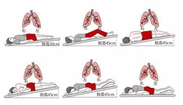 满足呼吸治疗中的体位需求,头低脚高位便于进行急救及排痰操作