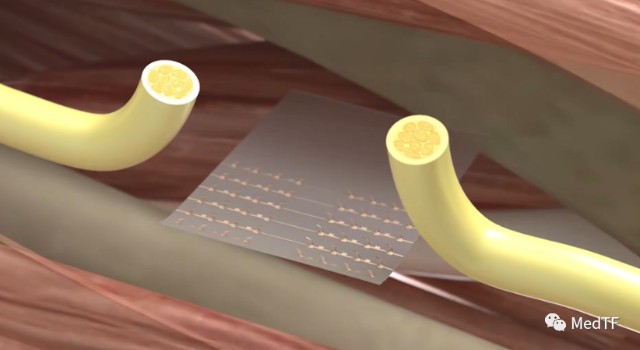 医疗MESH怎么用【MedTF盘点】MemoSorb全降解封堵器系统入选2022年十大创新医疗技术_https://www.jmylbn.com_新闻资讯_第19张