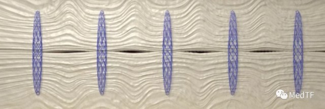 医疗MESH怎么用【MedTF盘点】MemoSorb全降解封堵器系统入选2022年十大创新医疗技术_https://www.jmylbn.com_新闻资讯_第11张