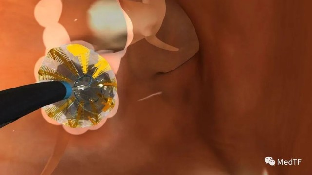 医疗MESH怎么用【MedTF盘点】MemoSorb全降解封堵器系统入选2022年十大创新医疗技术_https://www.jmylbn.com_新闻资讯_第23张