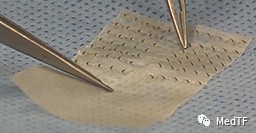 医疗MESH怎么用【MedTF盘点】MemoSorb全降解封堵器系统入选2022年十大创新医疗技术_https://www.jmylbn.com_新闻资讯_第20张