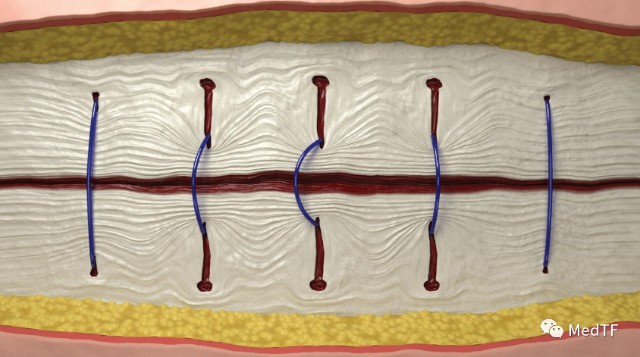 医疗MESH怎么用【MedTF盘点】MemoSorb全降解封堵器系统入选2022年十大创新医疗技术_https://www.jmylbn.com_新闻资讯_第9张