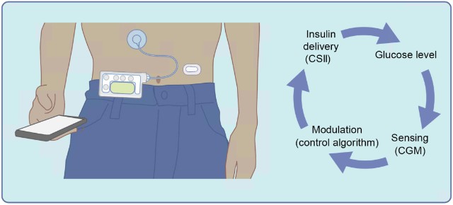 其整體構造包括連續血糖監測儀,胰島素泵和自動調節皮下胰島素輸送量