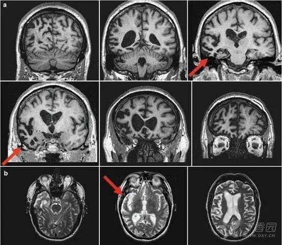 好莱坞影星患额颞叶痴呆,中青年警惕脑功能异常