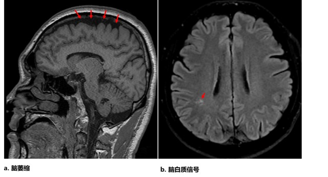 好莱坞影星患额颞叶痴呆,中青年警惕脑功能异常