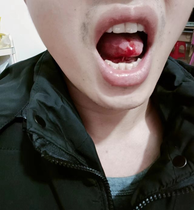 舌头被割下来的图片图片