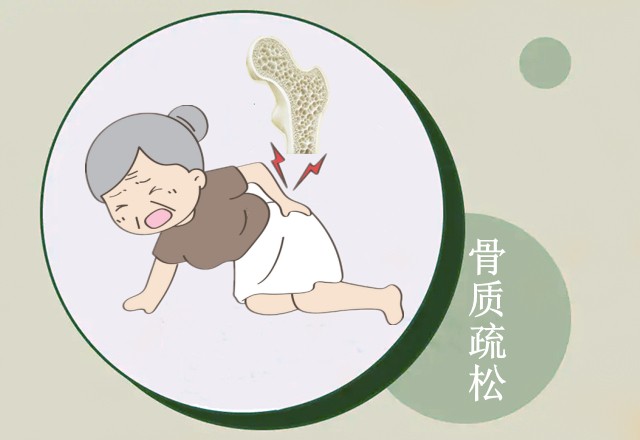 维兰尼梅奥医学科普:女性绝经后骨质疏松的原因是什么?