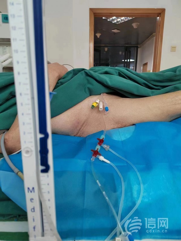 平度市人民医院重症医学科成功开展腹内压监测技术