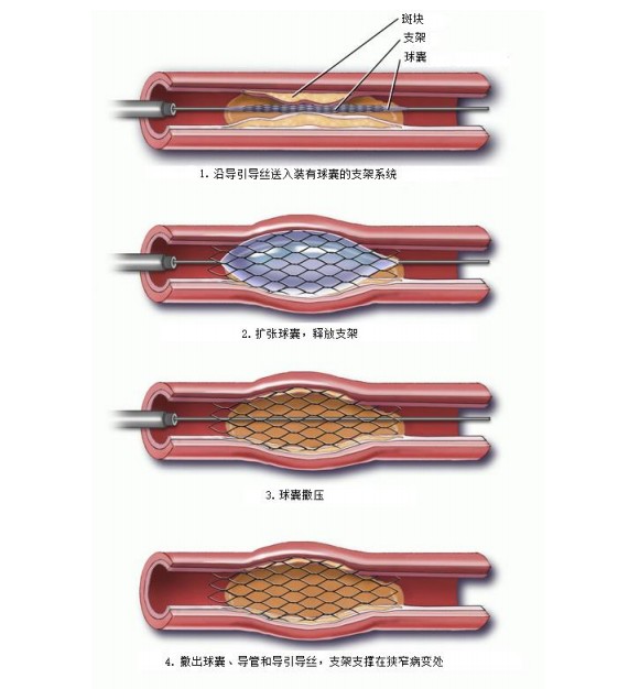 血管支架 示意图图片