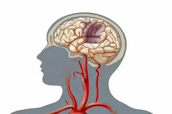 脑白质脱髓鞘病是怎么引起的