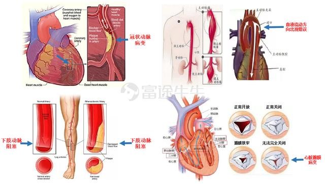 一文读懂高瓴持仓的心血管医疗器械赛道