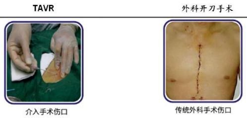 一文读懂高瓴持仓的心血管医疗器械赛道