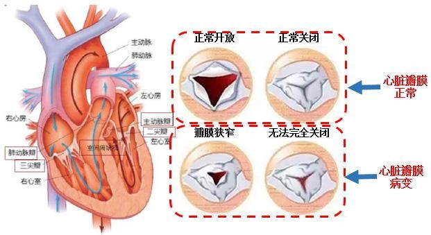 一文读懂高瓴持仓的心血管医疗器械赛道