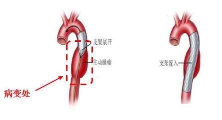 一文读懂高瓴持仓的心血管医疗器械赛道