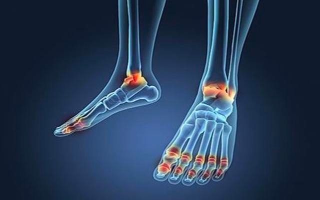 痛是一阵风痛到你发疯做好4件事这个夏天与痛风说拜拜