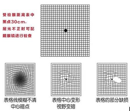 变形,或者视野中心出现暗点,这些症状都可以使用阿姆斯勒(amsler)表