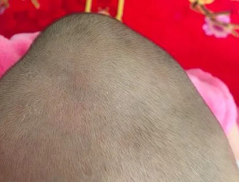 核保案例九新生儿头皮血肿