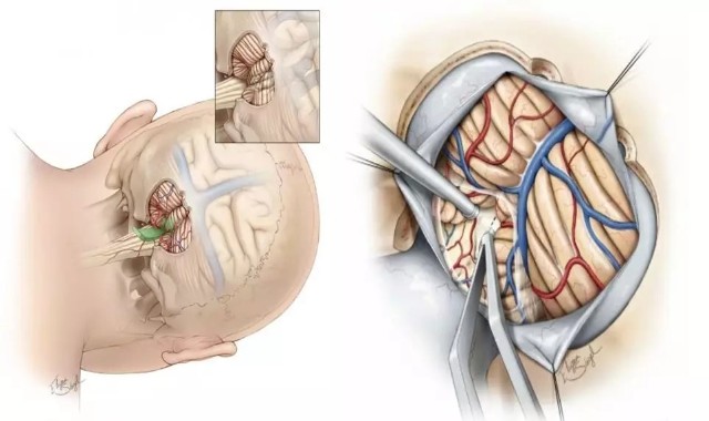 腦幹腫瘤命懸一線她如何躺著入院術後15天走著出院