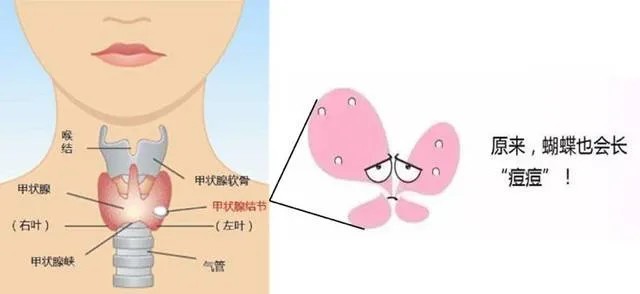 甲状腺自检方法图片