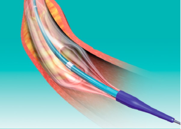 蓝帆医疗biofreedom64支架rise64nc球囊扩张导管获注册证可大幅