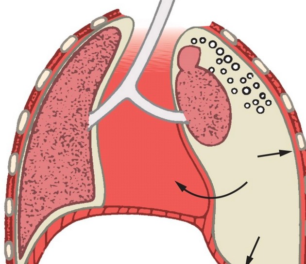 一種情況是胸腔遭受外力衝擊引發胸膜穿孔,外界氣體進入胸腔內,擠壓