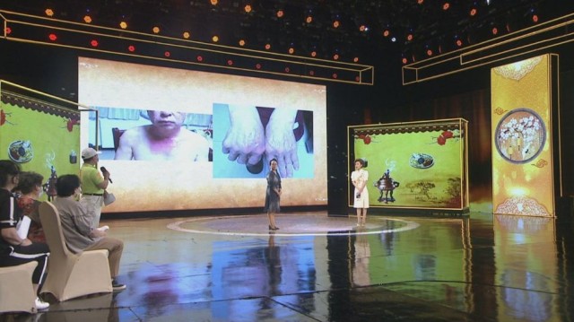 东城中医医院郭玉琴主任做客《健康北京》：湿疹不仅是皮肤的事！_财富 