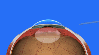 利润暴增9倍!人工晶体,长在眼睛里的摇钱树
