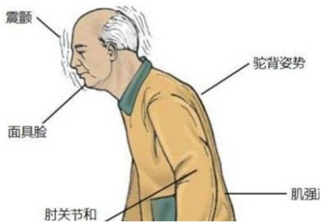 共济失调需要和哪些疾病进行鉴别