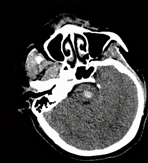 脑干可见片状高密度影,测其最大层面约18 mm15 mm 20 mm,ct值约65 hu.