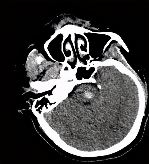 脑干出血的ct片子图片图片
