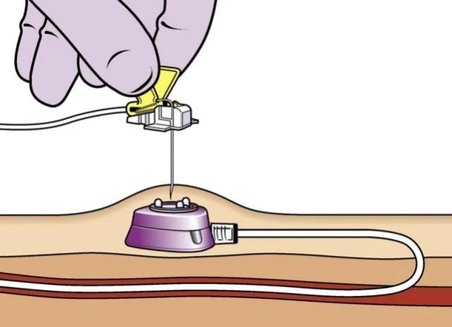 合肥京东方医院化疗患者进入了输液港时代