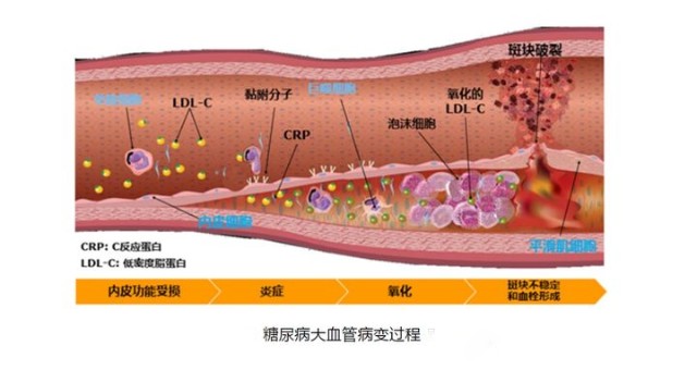 一方面,在高糖化的血液中,低密度脂蛋白(ldl)轉化為糖化低密度脂蛋白