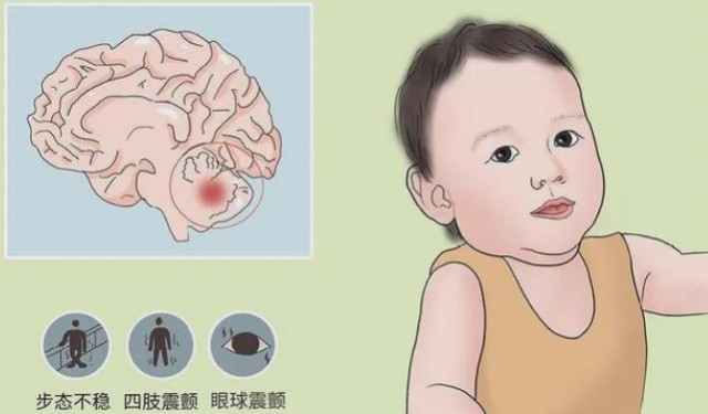 小儿小脑共济失调有哪些症状