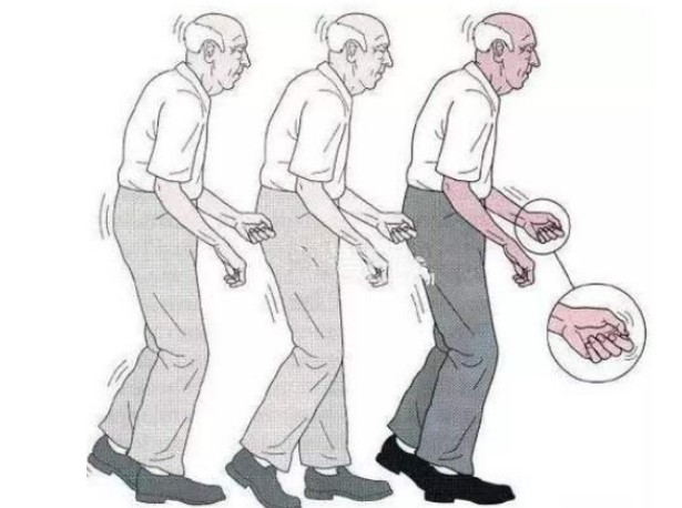 稳,走路时步基加宽,左右摇摆,不能沿直线前行,蹒跚而行,又称醉汉步态