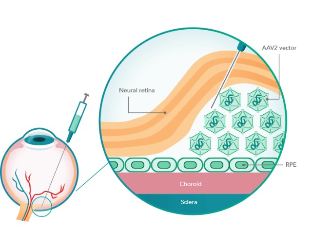 血眼屏障有助于眼部免疫特权,针对基因治疗产品的免疫反应有限.