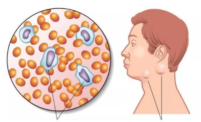 淋巴瘤是起源於淋巴造血系統的惡性腫瘤,可發生於身體的任何部位,臨床