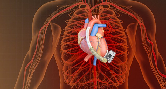 国产首个蓝帆入股全磁悬浮人工心脏获批