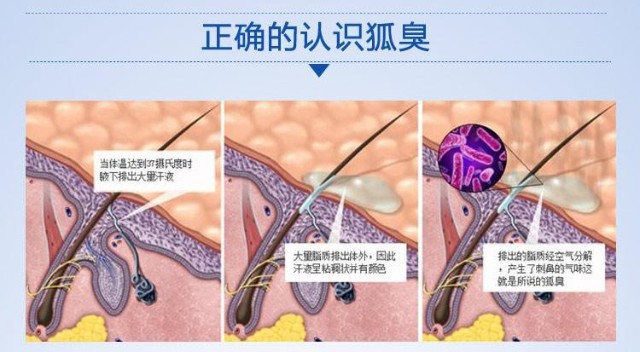 狐臭的根本原因就是大汗腺細胞管壁過大.