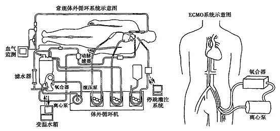 突发迈瑞强势入局ecmo